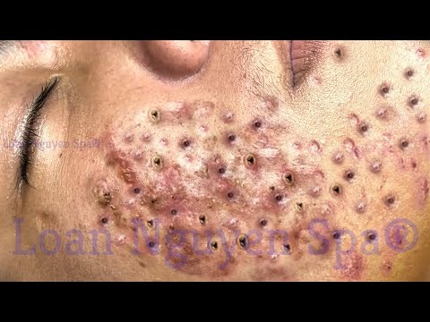 Blackhead Removal With Sac Dep Spa @100074214