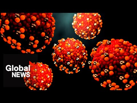 YouTube video thumbnail: Alberta Surpasses All of the US in Confirmed Measles Cases