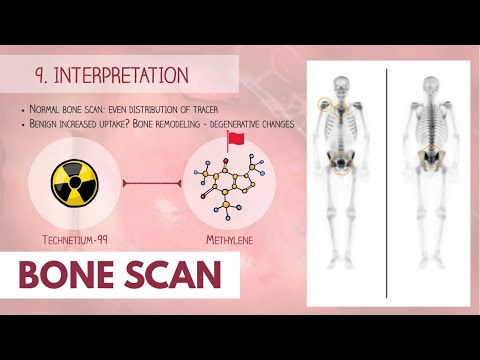 Bone Scan Procedure | Dr. Paulien Moyaert