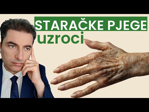 Zašto nastaju staračke pjege?
