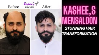 Kashee’s Men Salon – Tariq RoadFrom Bald to Bold ✨ | Stunning Hair Transformation 🔥