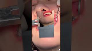 Tháo mắc cài, khởi đầu cho một nụ cười tự tin tại Hiromi❤️🦷