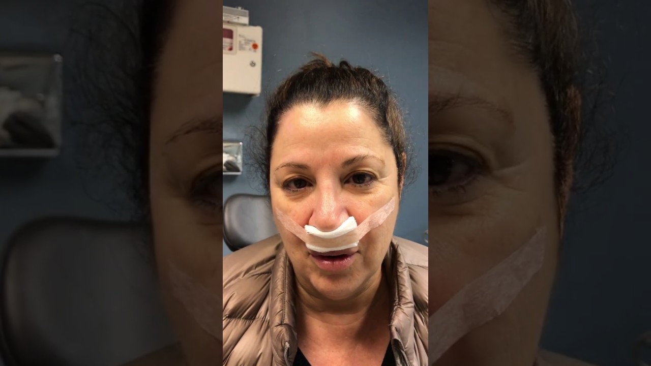Person with post-procedure nasal bandage looking forward.