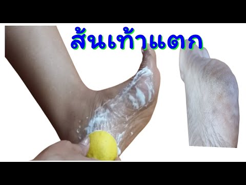 เท้าแตก  🦶  รักษาง่ายมาก | แค่ใช้ 2 สิ่งนี้  ครั้งเดียวเห็นผลทันที