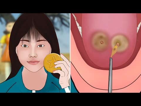 ASMR Animation Squid Game Player 222 Tongue Piercing Infection Treatment