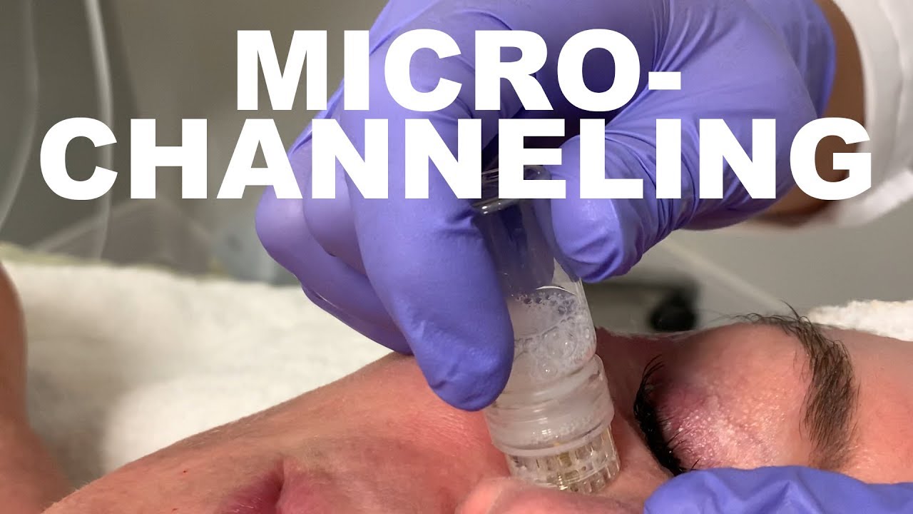 Micro-channeling facial treatment in progress.