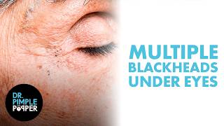 Multiple Blackheads Under the Eyes Safely Removed by Dr Pimple Popper