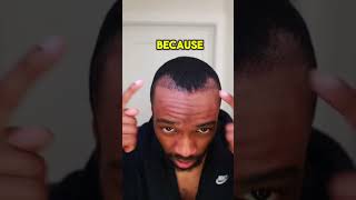 Day 6 Curing My Seborrheic Dermatitis