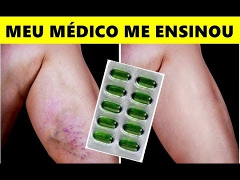 MINHAS PERNAS ESTAVAM cheias de VARIZES e MEU MÉDICO me falou DESSE TRUQUE caseiro!