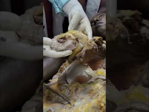 Superior mesenteric artery cut open, relation with pancreas and duodenum #shorts #anatomy