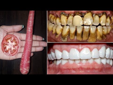 2 मिनट में गंदे पिले दांतो को मोती की तरह सफेद और चमकदार बना देगा ये नुस्खा // Teeth Whitening
