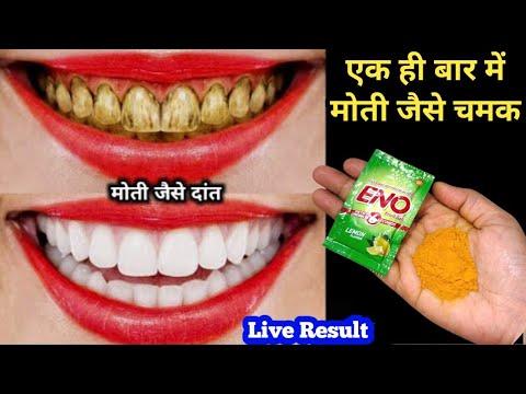गंदे पीले दांतो को सफेद करने का अनोखा तरीका आज तक आपने नहीं देखा होगा/teeth whitening only 5 minutes