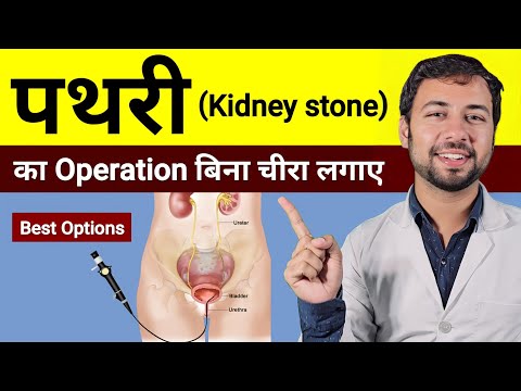 Kidney Stone Treatment | Pathri ka Operation kaise hota hai | Pathri ka ilaj | Pathri ka operation