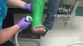 CAST REMOVAL!