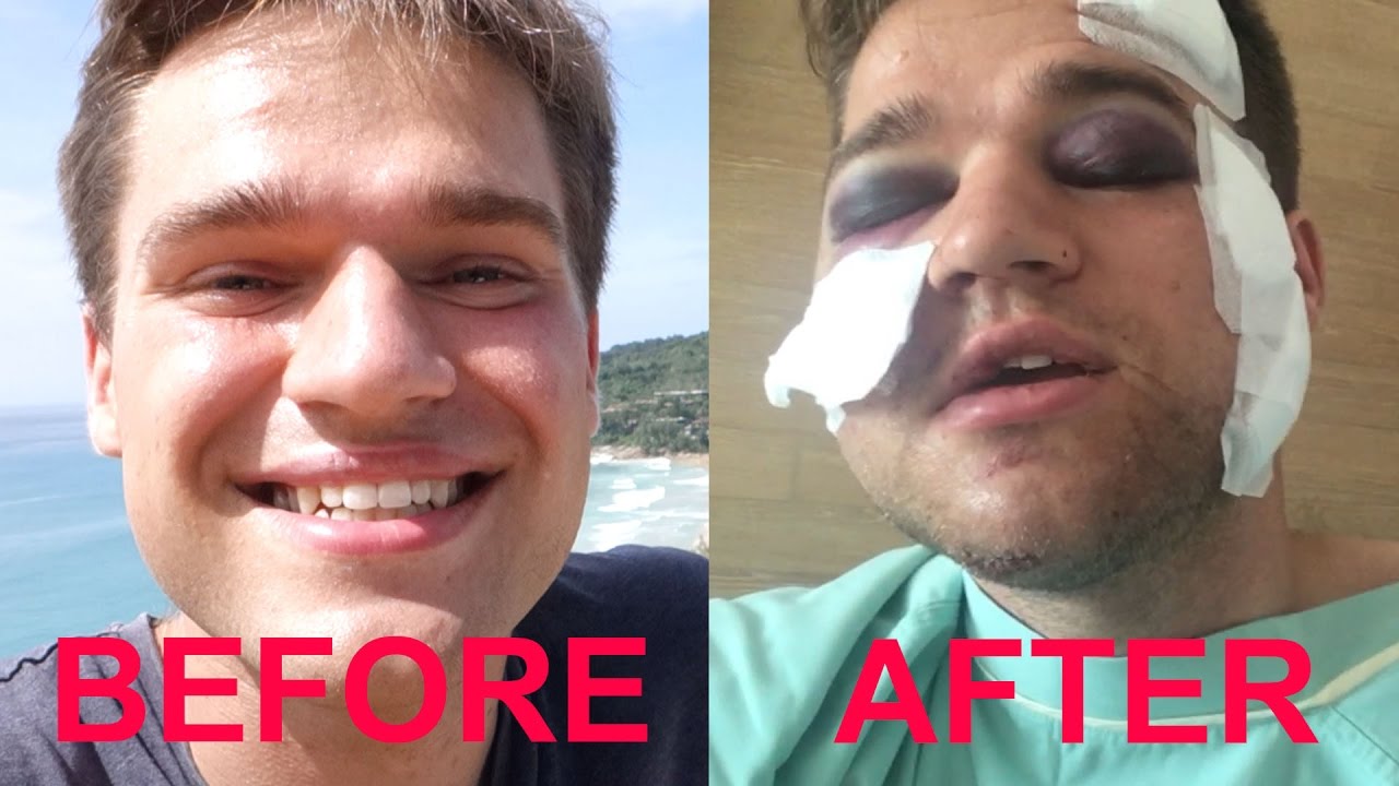 Near-Death Crash & $10, 000 Surgery In Thailand - Jacob Laukaitis