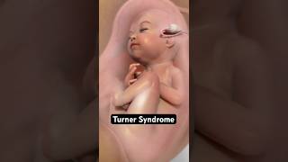 Why Some Girls Are Born With One X Chromosome