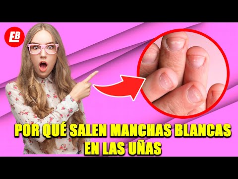 Por qué salen manchas blancas en las uñas