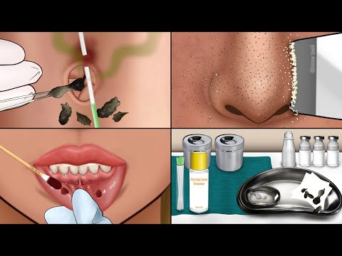 ASMR Very Satisfying Care Animation‼️ Piercing Cleaning, Navel Stone, Nose Sebum, Make up