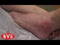 Understanding Pressure Ulcers and Skin Care
