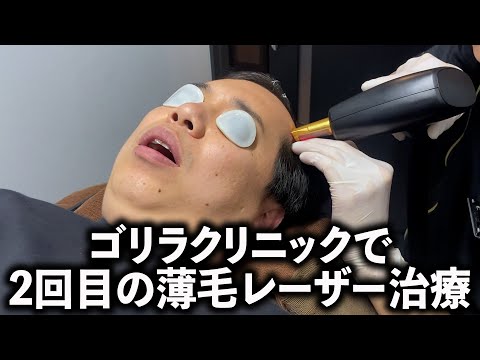 ゴリラクリニックで2回目の薄毛レーザー治療