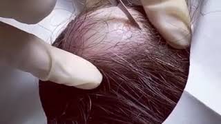 Pimple popping | Cyst popping | Прыщи | Гной | Киста | Голова | Жесть | Ужасы | Acne