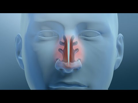 Nasal Turbinate Reduction