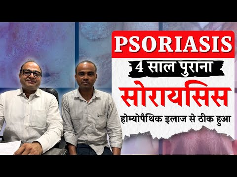सोरायसिस का चमत्कारी इलाज | 4 साल पुराना सोरायसिस होम्योपैथी इलाज से ठीक हुआ