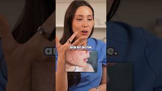 How to get rid of Acne #Howtogetridofacne #acne acne treatment