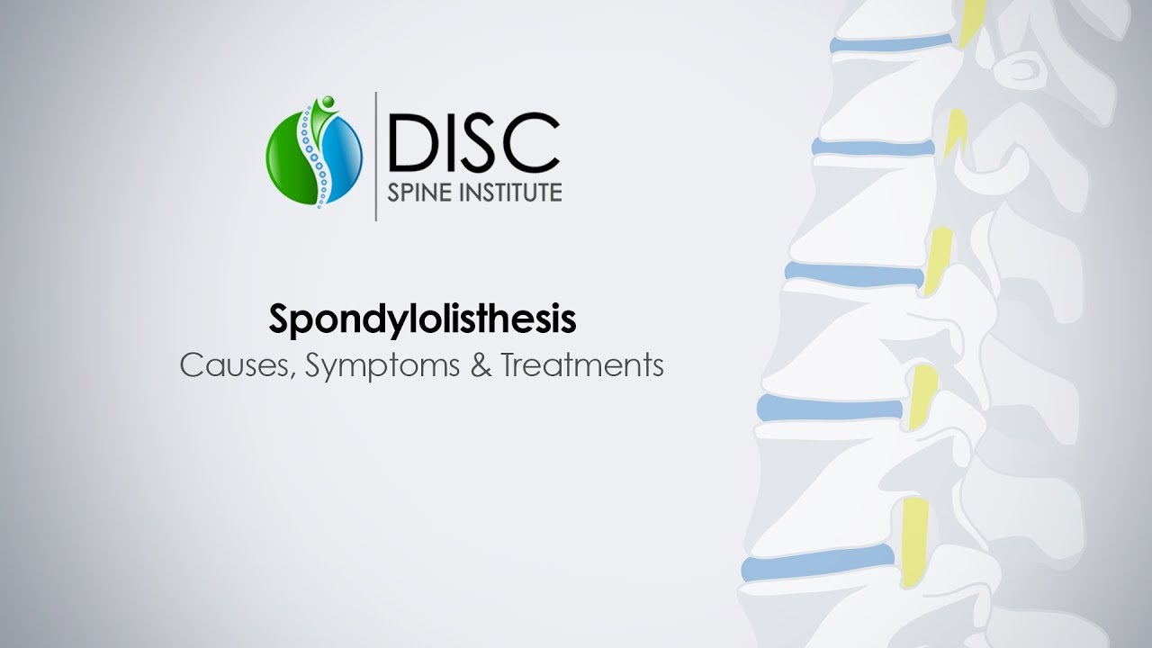 What is Spondylolisthesis