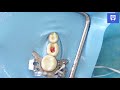 Pulpotomy Procedure and Techniques
