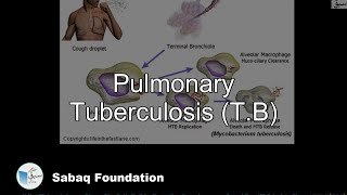 Pulmonary Tuberculosis  (T.B)