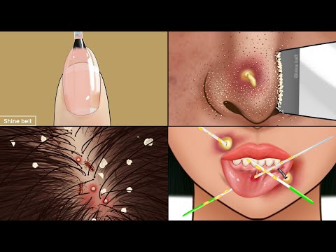 ASMR Satisfying Care Animation‼️ Piercing Cleaning, Navel Stone, Nose Sebum, Make up