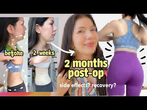 Liposuction in Korea 🇰🇷 complications, recovery | Chin & 360 Liposuction VLOG and Q&A