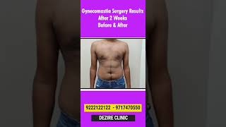 2 WEEKS POST-OP Gyno Result #shorts