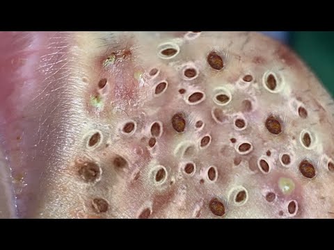 Blackhead Removal With Sac Dep Spa @100074555