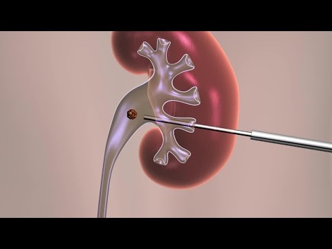 percutaneous placement nephrolithotomy