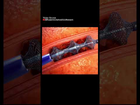milli-spinner | the device that can save your life