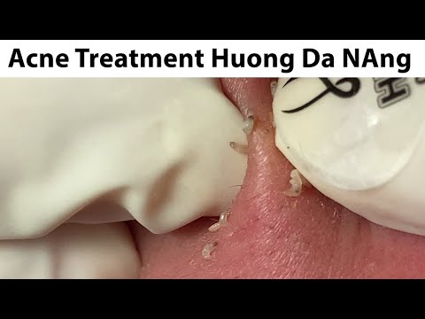 Acne Treatment Huong Da Nang# 719#Merry Christmas 2024