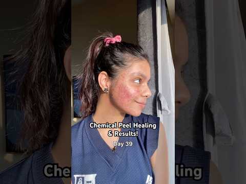 I got Chemical Peel treatment for my severe acne🫣 Healing and Results #chemicalpeel #acnetreatment