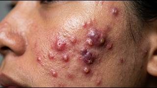 Loan Nguyen Acne Treatment 17zz
