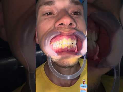 ازالة جير الاسنان وتنظيف اللثه #dr_abdullah_sultan_dentist