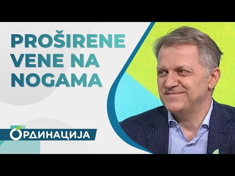 Kako se izboriti sa proširenim venama na nogama | RTS ordinacija