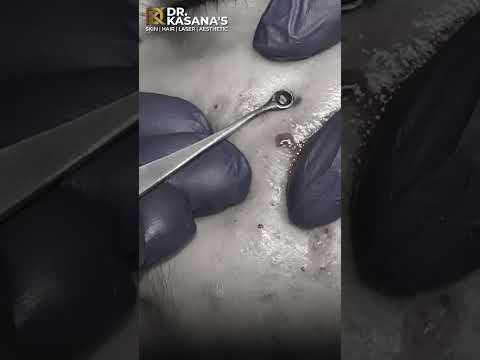 Blackheads Removal By Dr. Lalit #blackheads