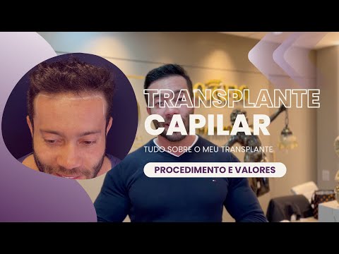 Tudo sobre o meu Transplante Capilar. Cabelo Vin Diesel nunca mais!