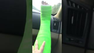 Getting my new cast