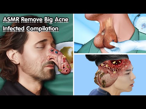 ASMR Remove Big acne, Maggot Infected Compilation - Deep Cleaning Animation