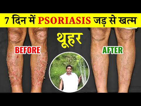 7 दिनों में psoriasis जड़ से खत्म | thor ka ped | Thuhar ke fayde | Psoriasis completely eradicated