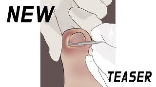 발톱이 살을 파고들었어요… 치료받는 소리까지 들려드립니다🦶✨ | 편안한 ASMR 애니메이션