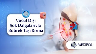 Hızlı ve Konforlu Böbrek Taşı Tedavisi: Şok Dalga Operasyonu