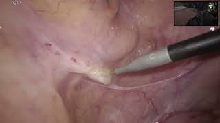(uncut) Laparoscopic TME with colostomy